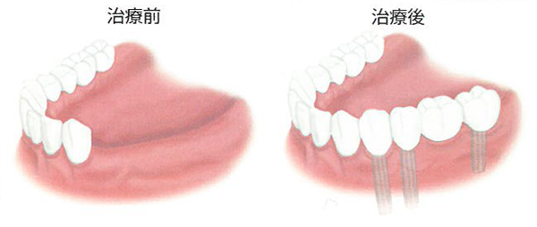 歯を何本か失った場合のインプラント