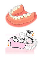 入れ歯・義歯