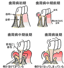 歯周病治療