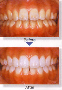 Tionティオンホームホワイトニング