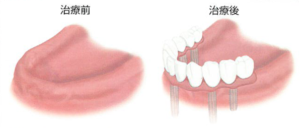 歯を全て失った場合のインプラント